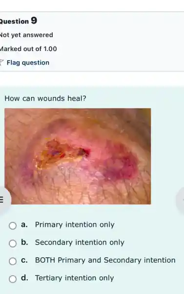 Question 9
Not yet answered
Marked out of 1.00
How can wounds heal?
a. Primary intention only
b. Secondary intention only
c. BOTH Primary and Secondary intention
d. Tertiary intention only